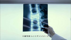 いつのまにか骨折