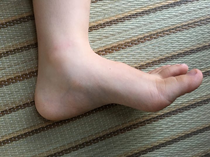 踵の痛み