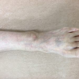 足くび　捻挫