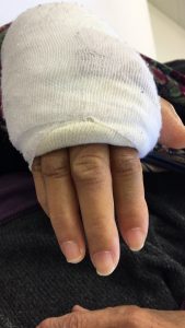 ギプス固定　正面