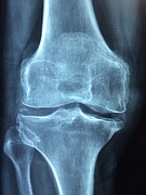 膝のレントゲン写真