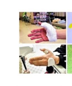 母指プライトン固定